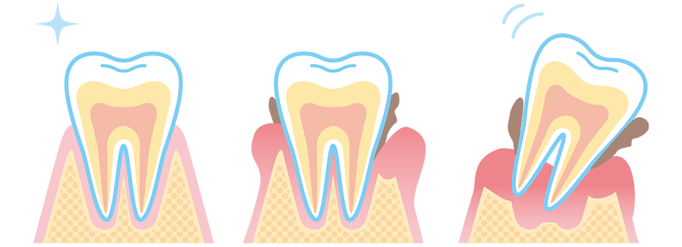 30歳以上の成人の約80%がかかっていると言われる歯周病。