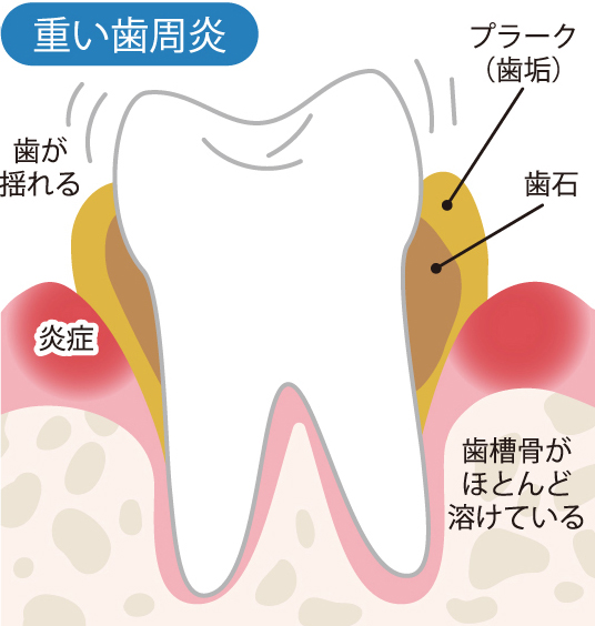歯周病を引き起こす歯周病菌