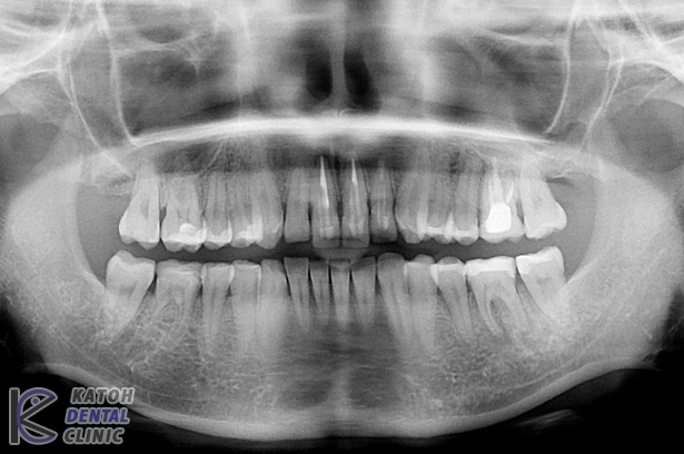 前歯の症例