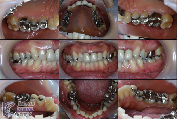 前歯の症例