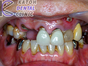 臼歯部インプラント