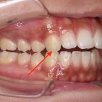 歯並びが悪いのは遺伝じゃありません。人類の８割が上顎が狭いからです。